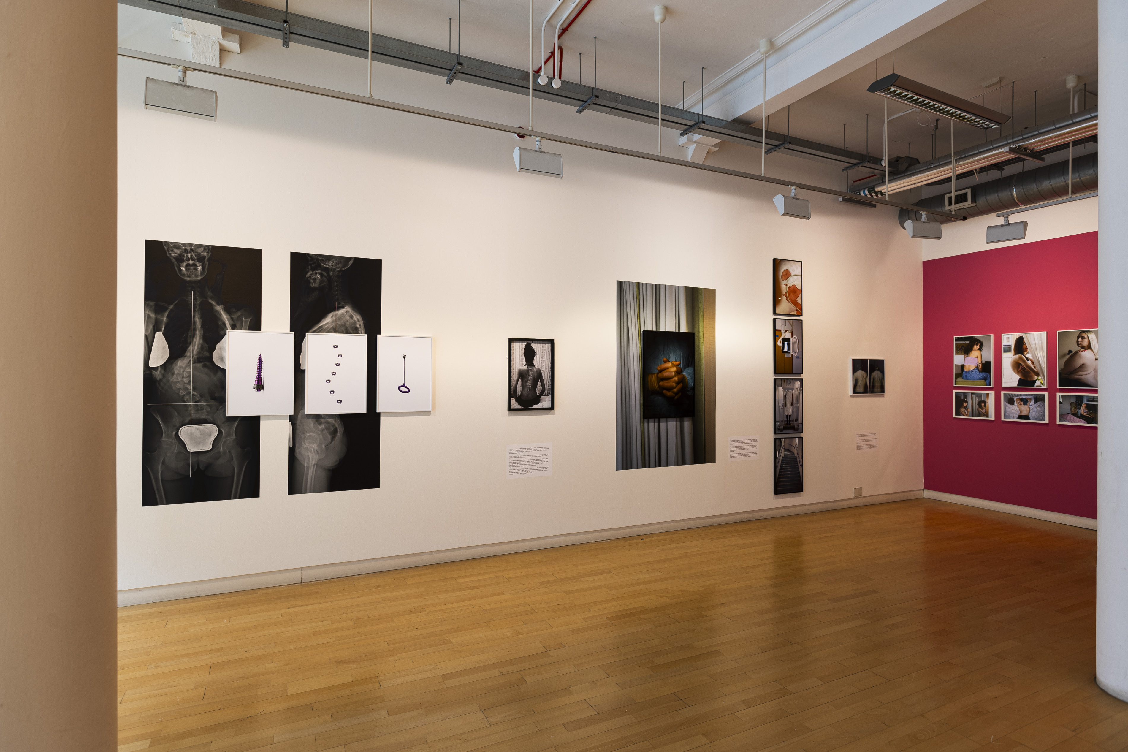 A gallery space at Streetlevel Photoworks showing large-scale spinal X-rays, framed images of surgical implants, and portrait photographs of bare backs, alongside a grid of colour photographs on a magenta wall, part of Ayesha Jones' exhibition on scoliosis.