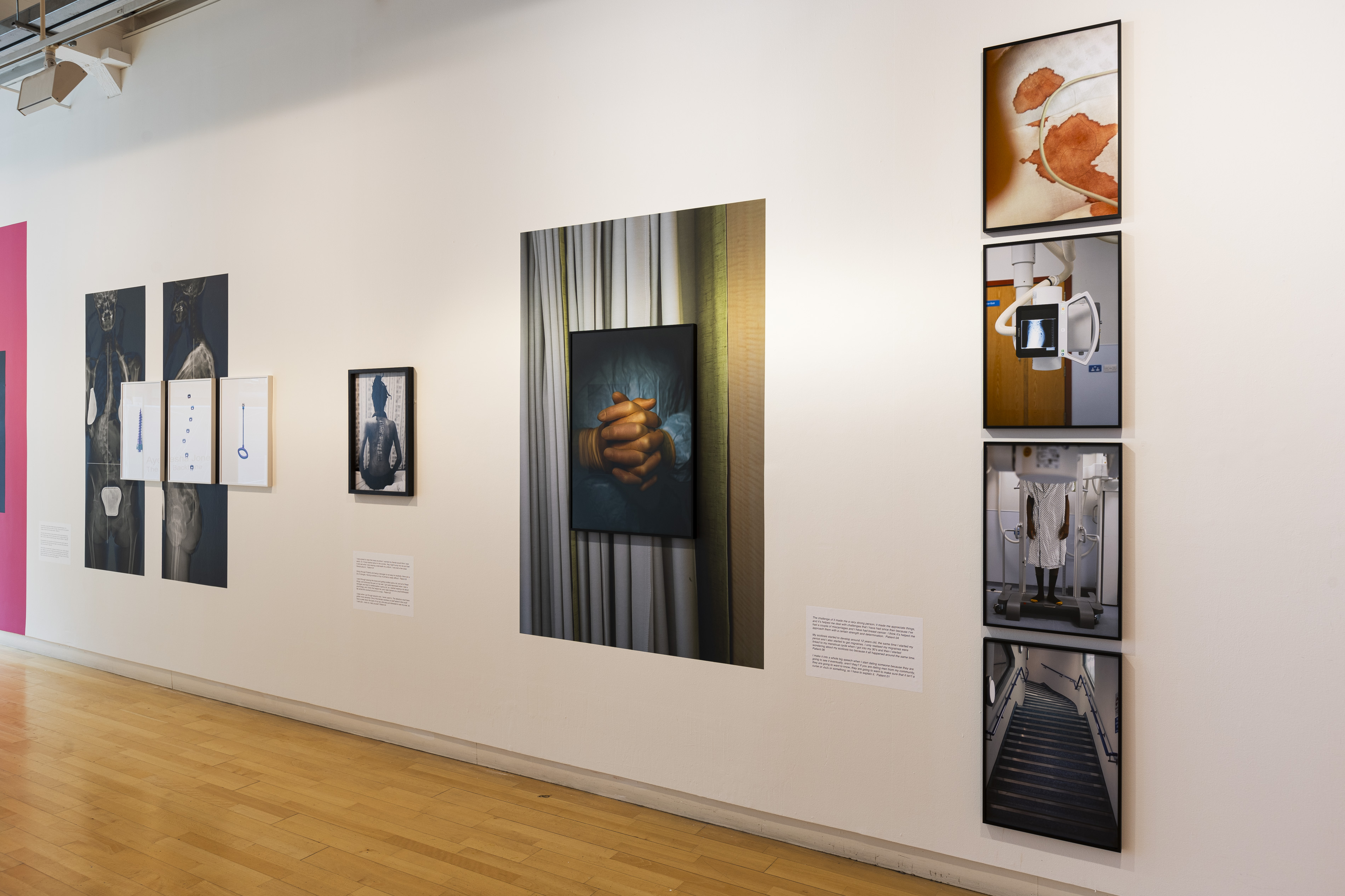 A gallery wall displaying spinal X-rays, small framed images of surgical hardware, a portrait of a scarred back, wall text, and a close-up photograph of clasped hands, alongside a vertical sequence of medical and clinical images, part of Ayesha Jones' exhibition.